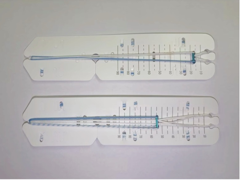 ACL Reconstruction: Graft Fixation Methods, Techniques and Key Considerations 3 ACL reconstruction cortical suspensory fixation system with button and loop construct for femoral graft fixation