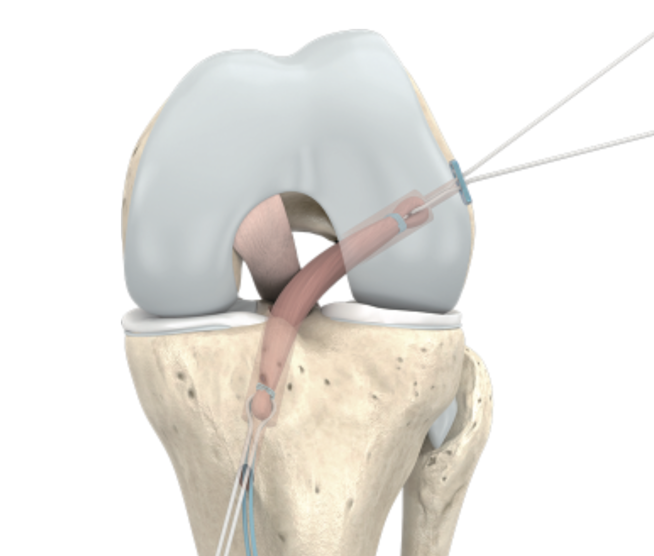 ACL graft being passed through femoral and tibial bone tunnels during knee ligament reconstruction surgery