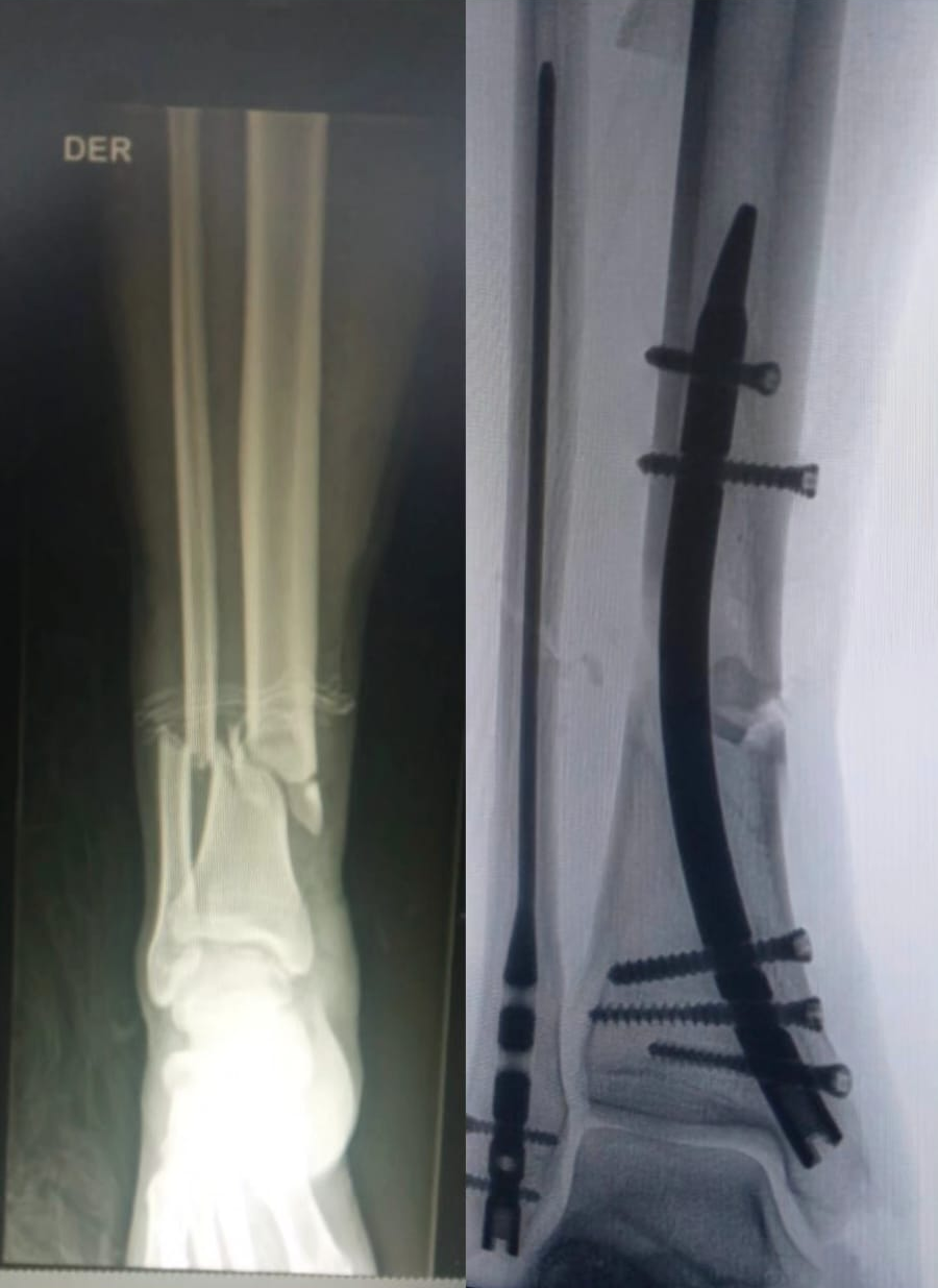 Distal Tibial Fracture Treatment: When Is Intramedullary Nailing Used? 2 Distal tibial fractures can be challenging to treat because the distal tibia has limited soft-tissue coverage and is located close to the ankle joint. Treatment decisions depend on the fracture pattern, degree of displacement, articular involvement, bone quality, and condition of the surrounding soft tissues.
